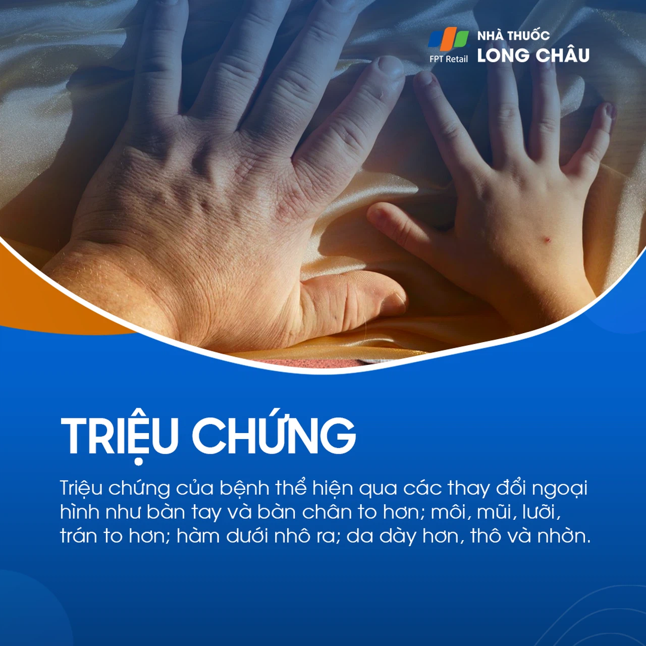 Bệnh to các viễn cực 2