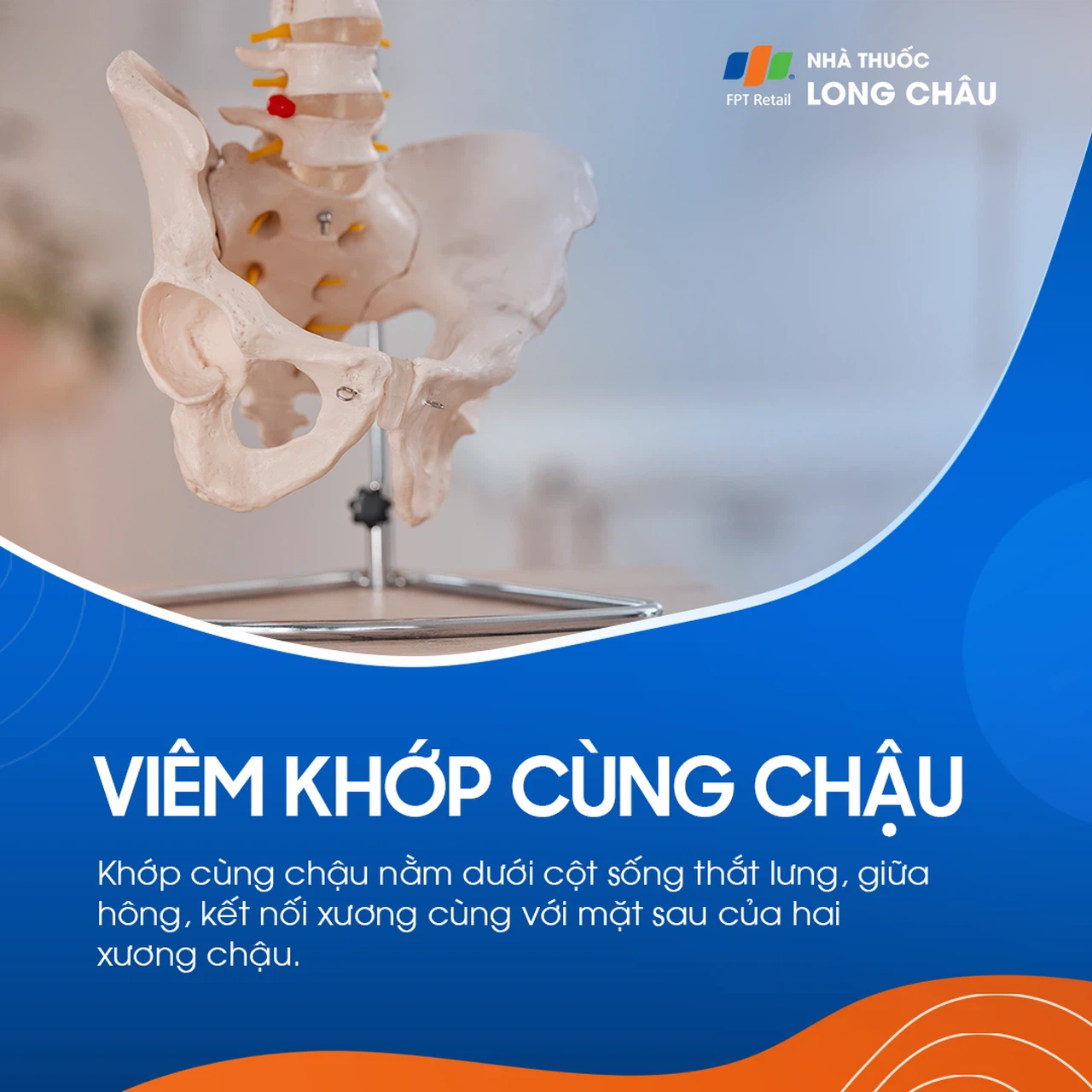 Viêm khớp cùng chậu 1