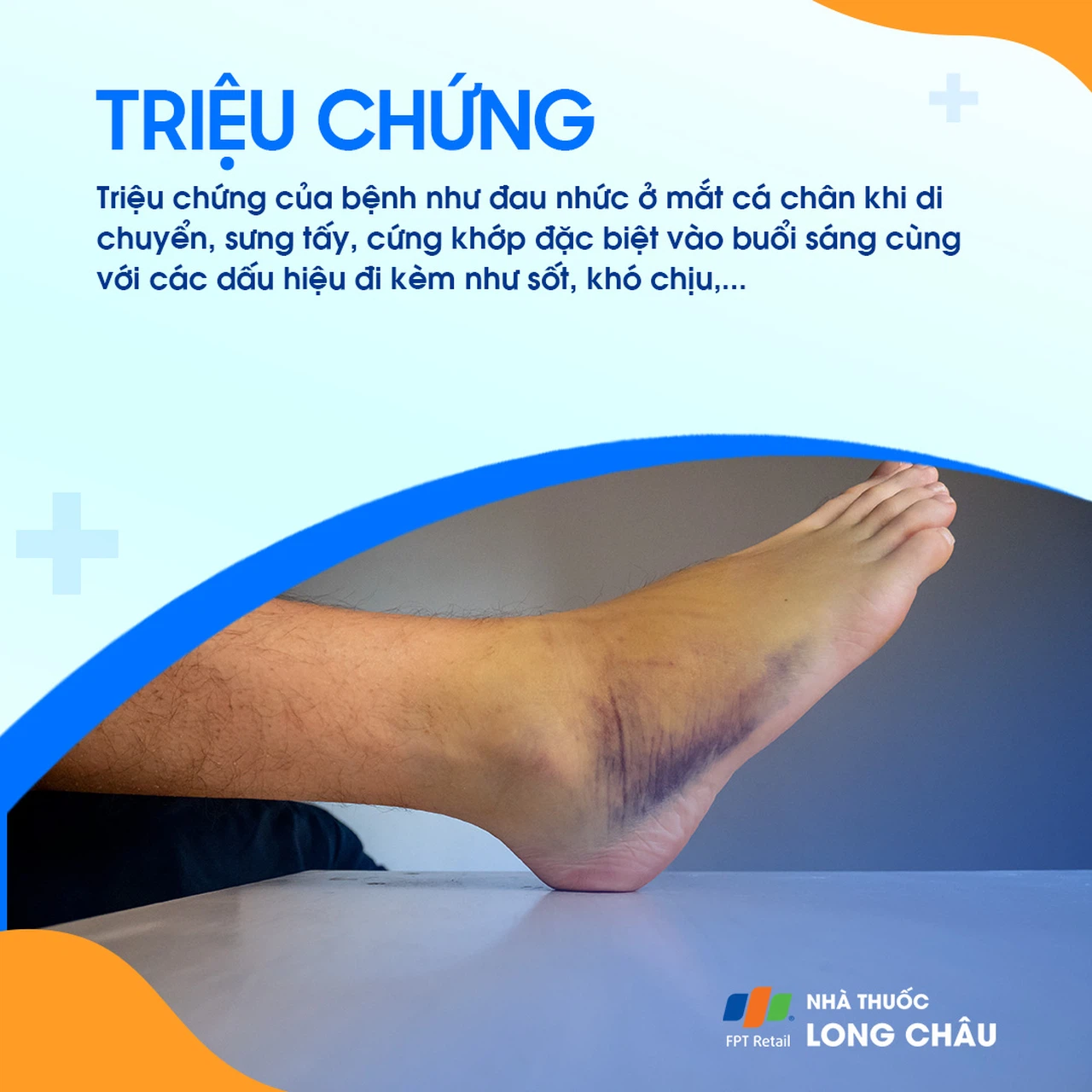 Viêm khớp mắt cá chân 3
