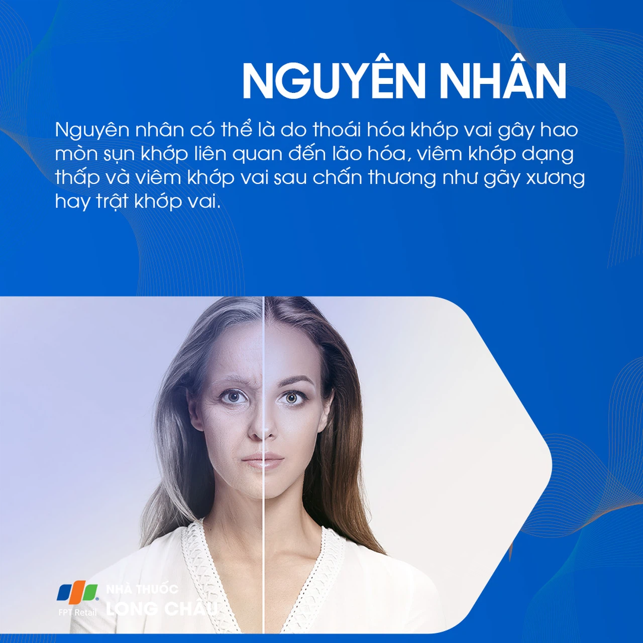 Viêm khớp vai 3