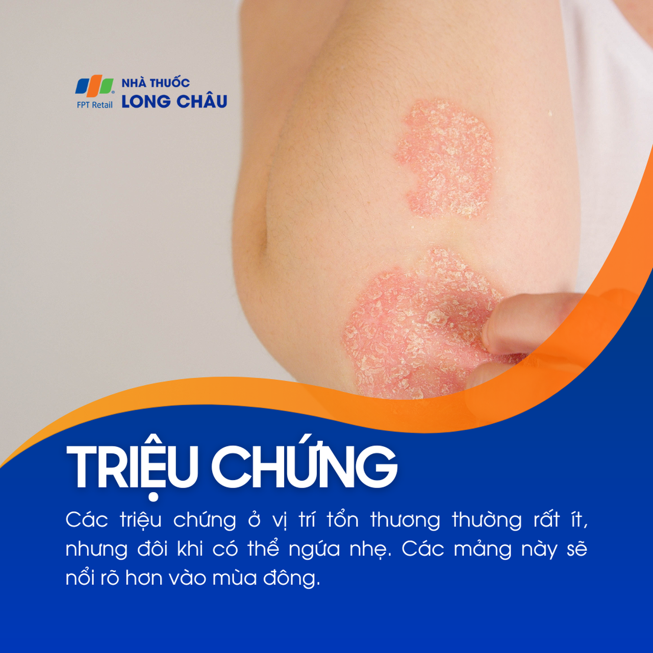 Á vảy nến 2