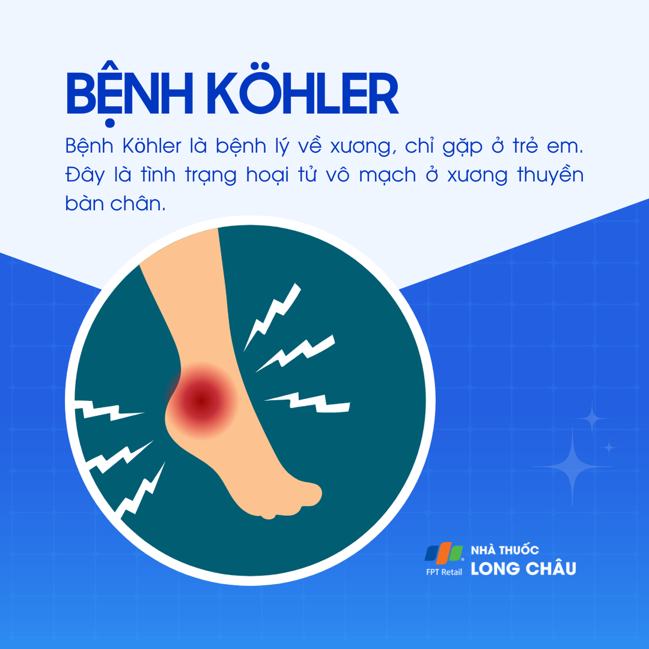 Bệnh Kohler 1