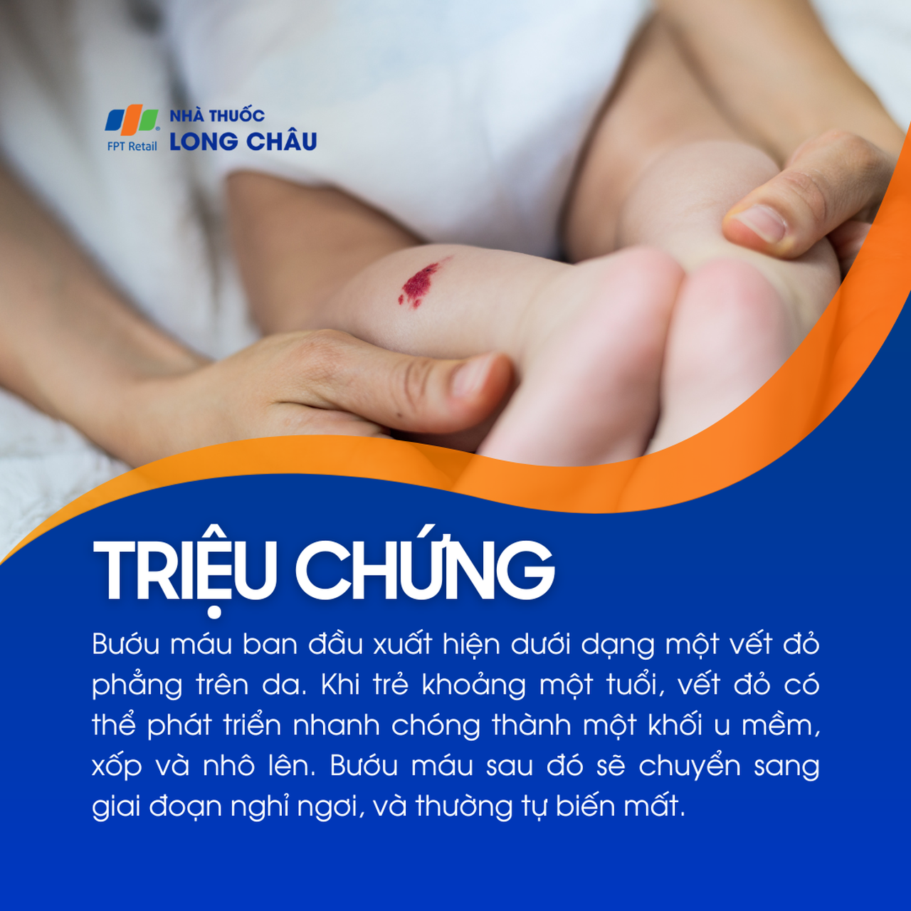 Bướu máu 2