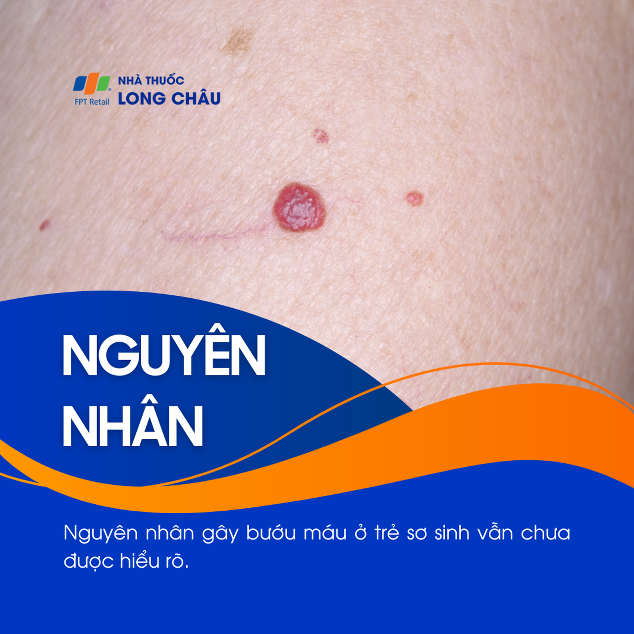 Bướu máu 3