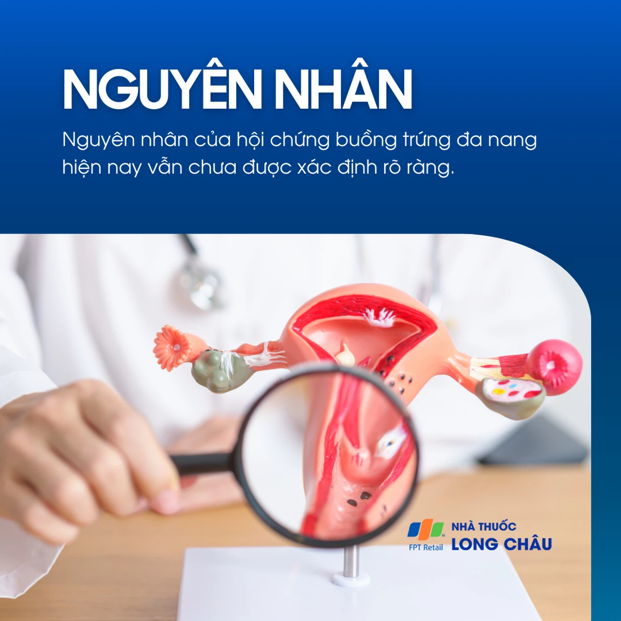 Hội chứng buồng trứng đa nang 3