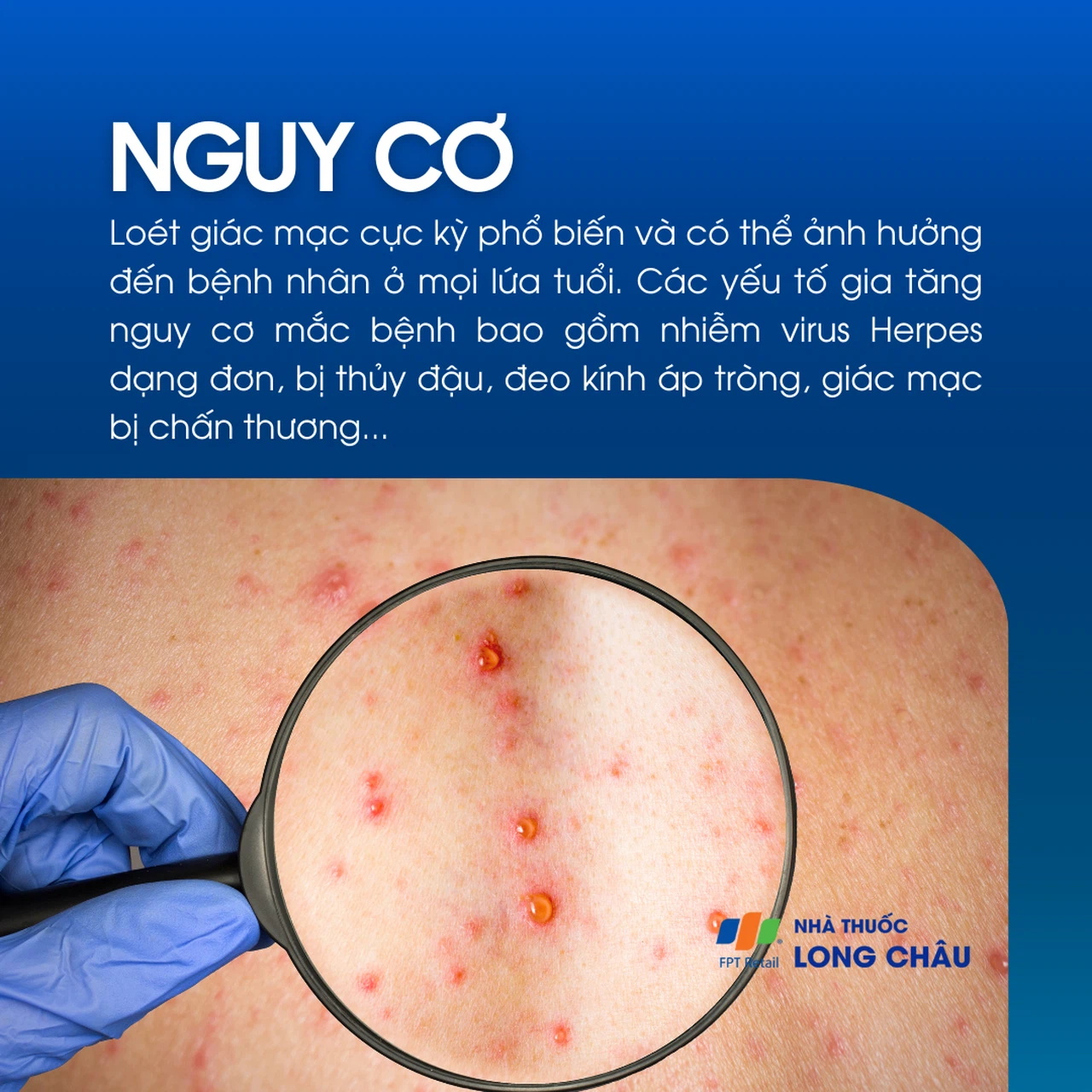 Loét giác mạc 4