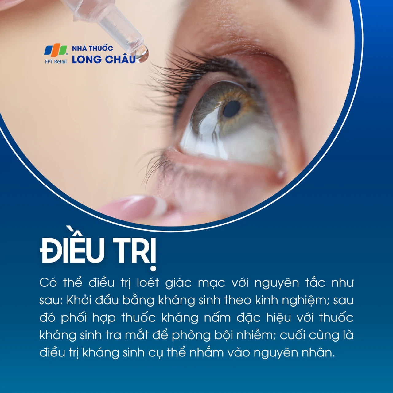 Loét giác mạc 6