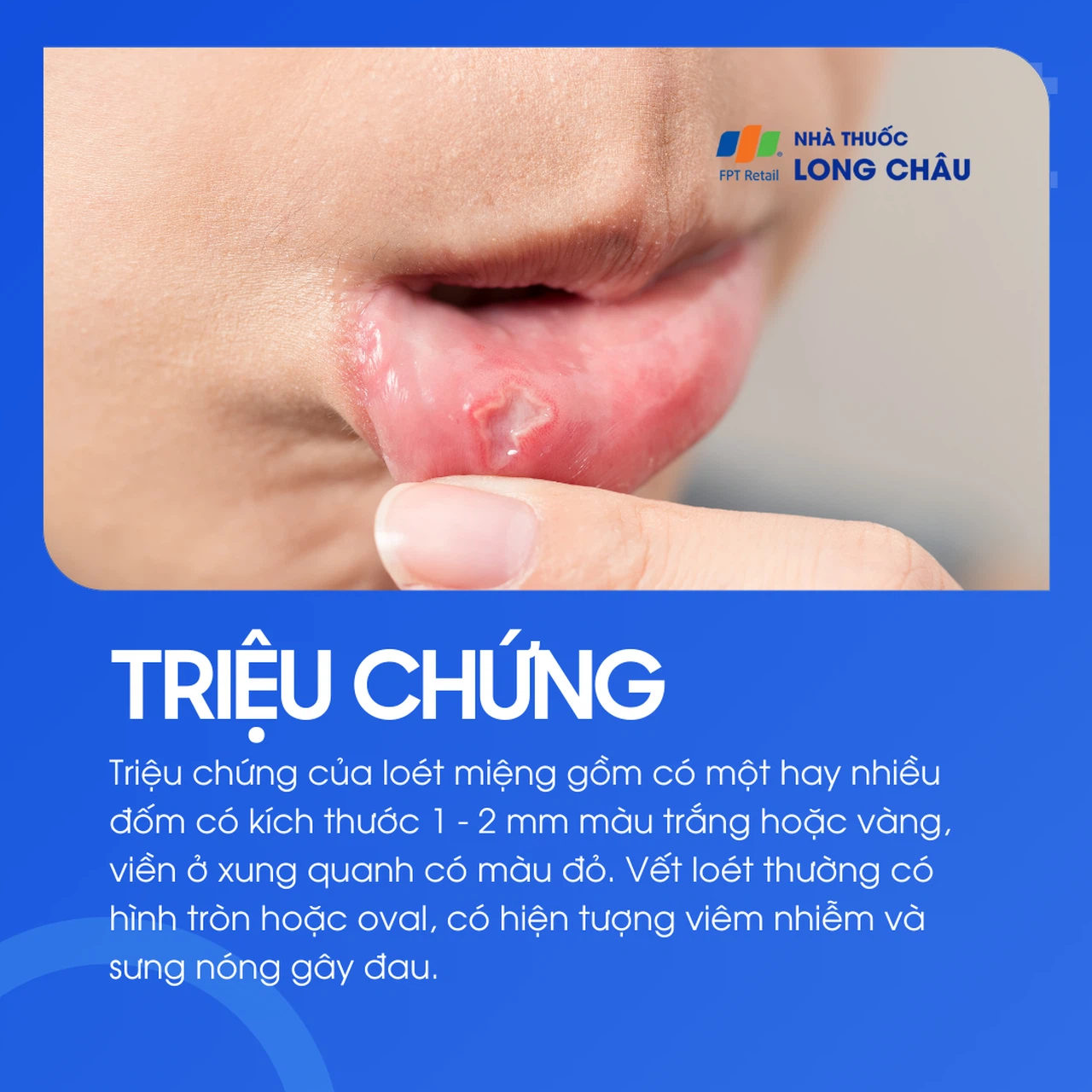 Loét miệng 2