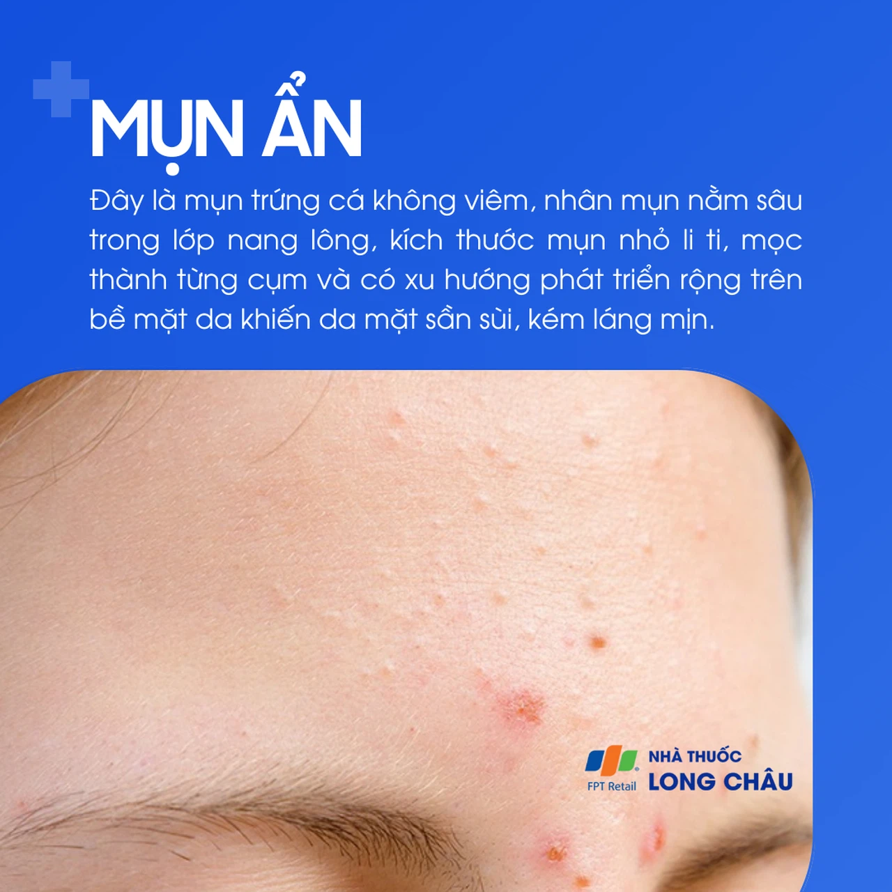 Mụn ẩn 1