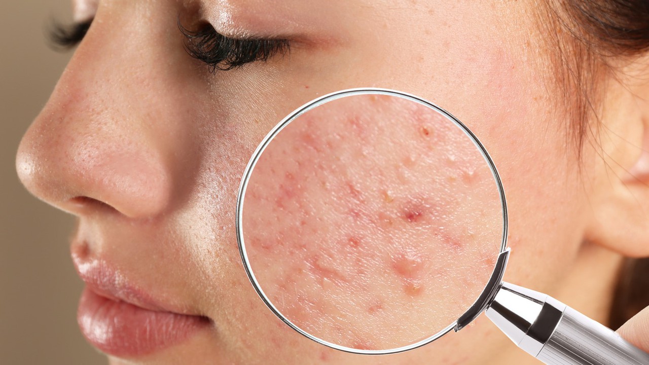Mụn bọc là gì? Những điều bạn cần biết về mụn bọc