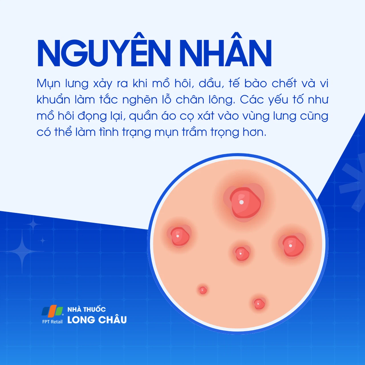 Mụn lưng 3