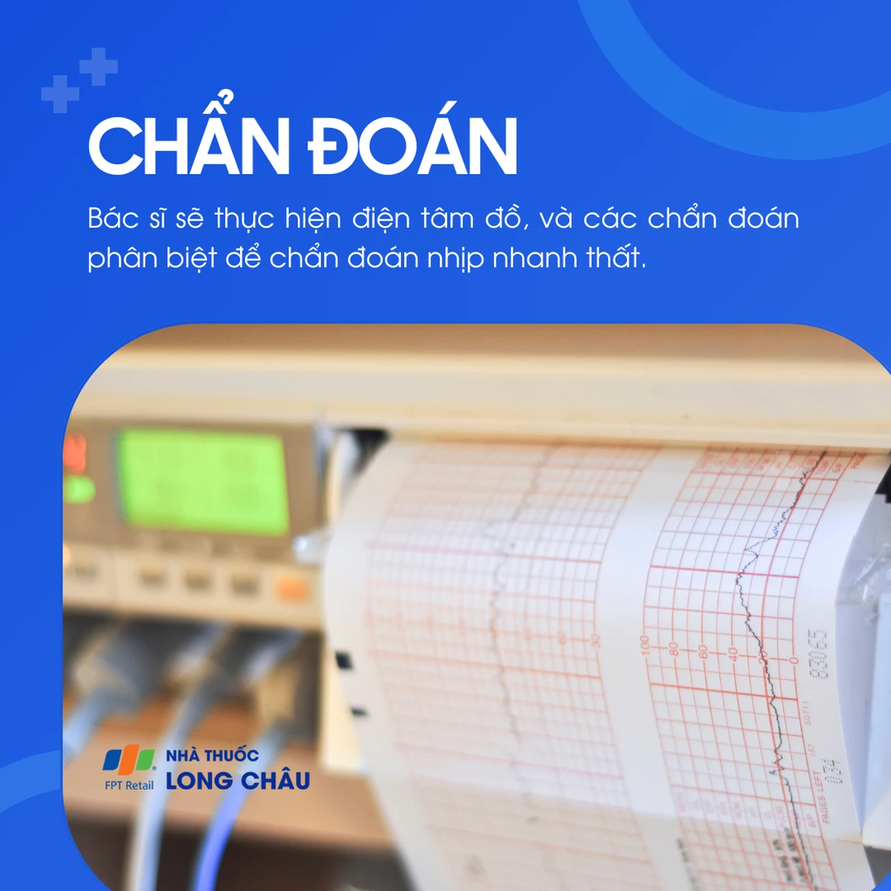 Nhịp nhanh thất 5