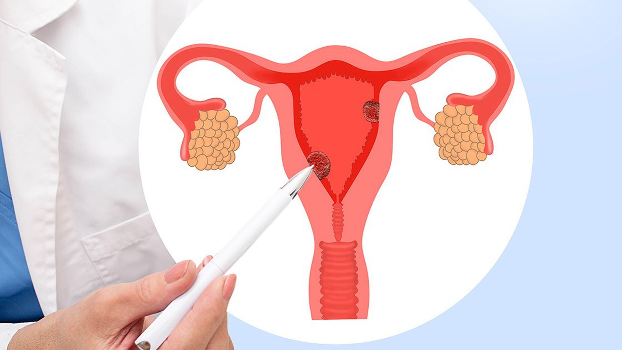 Polyp lòng tử cung là gì?