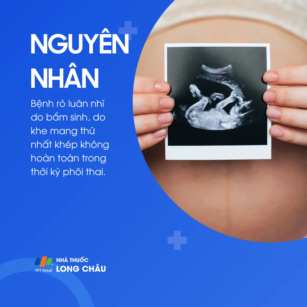 Rò luân nhĩ 3