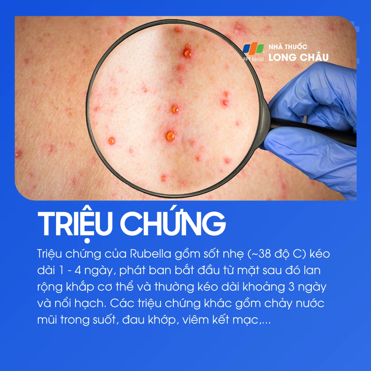 Rubella 2