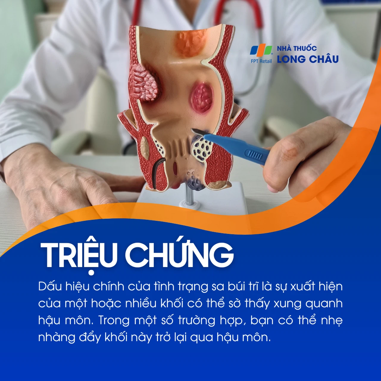 Sa búi trĩ 2