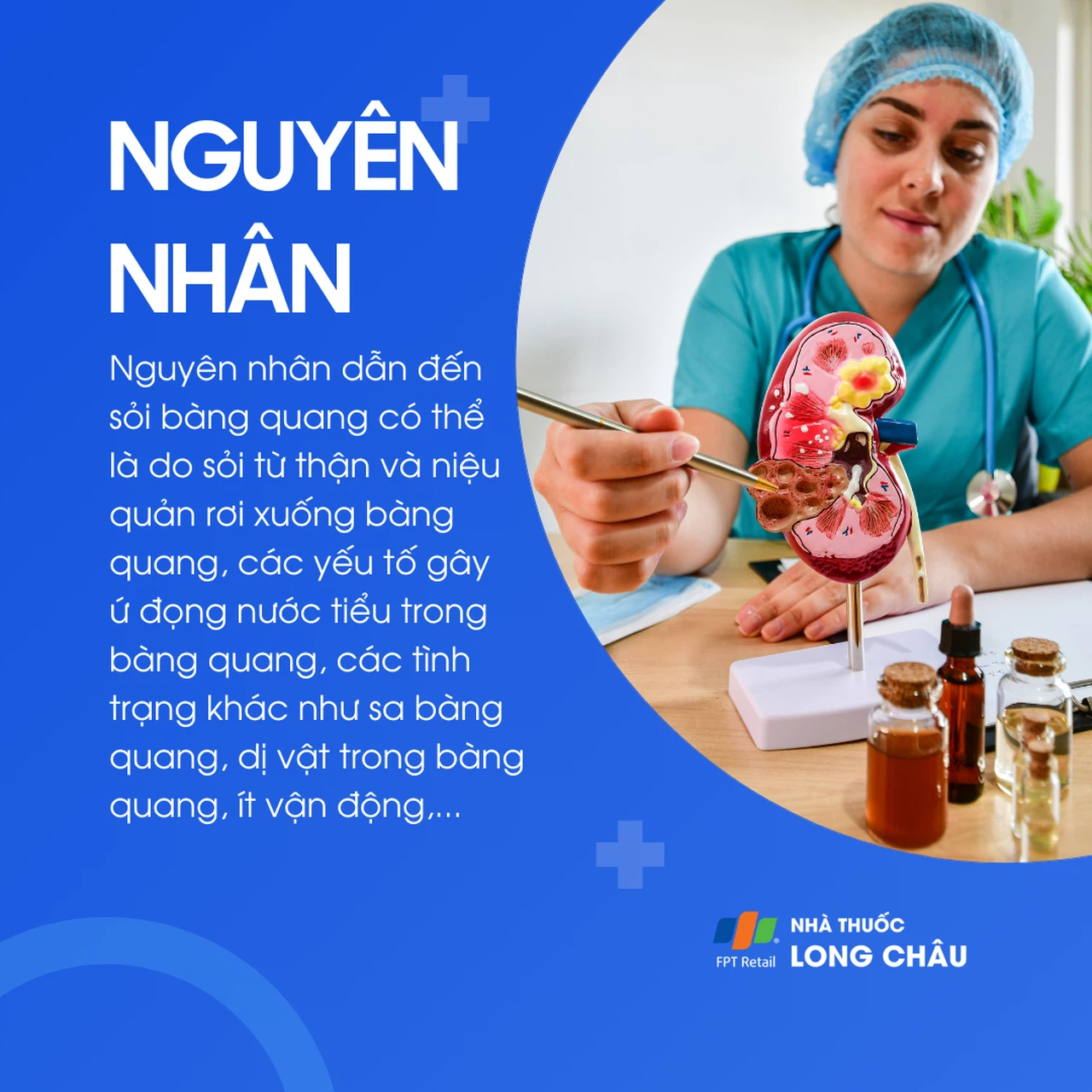 Sỏi bàng quang 3