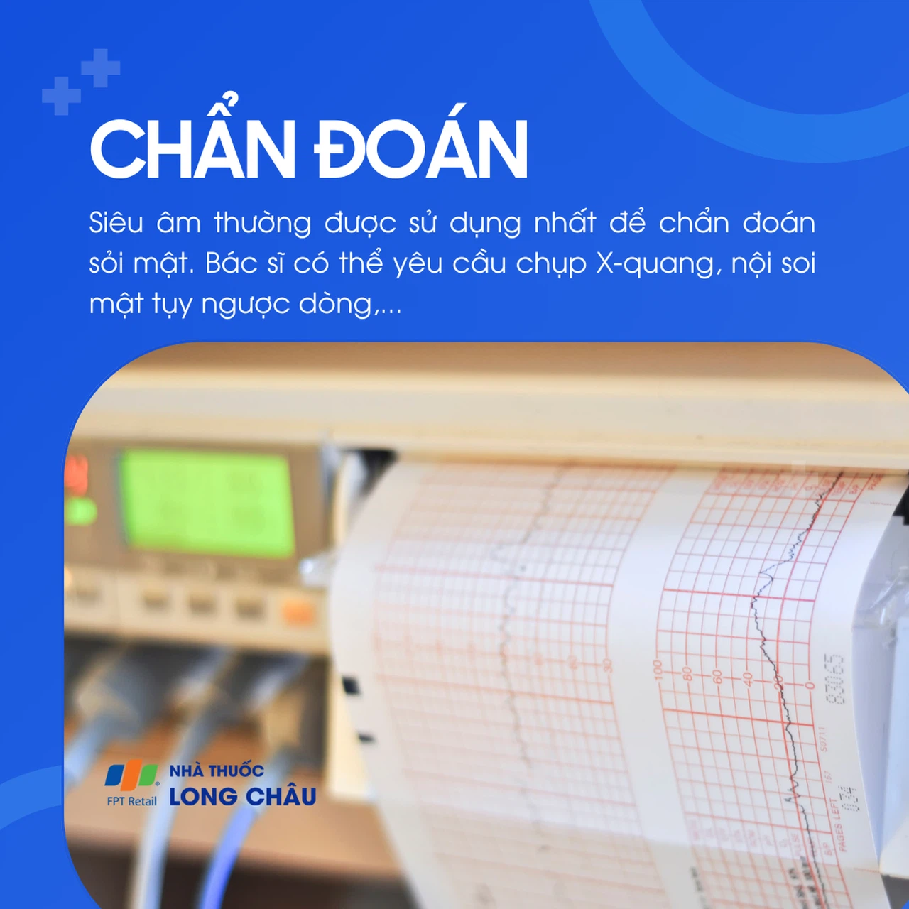 Sỏi mật 5