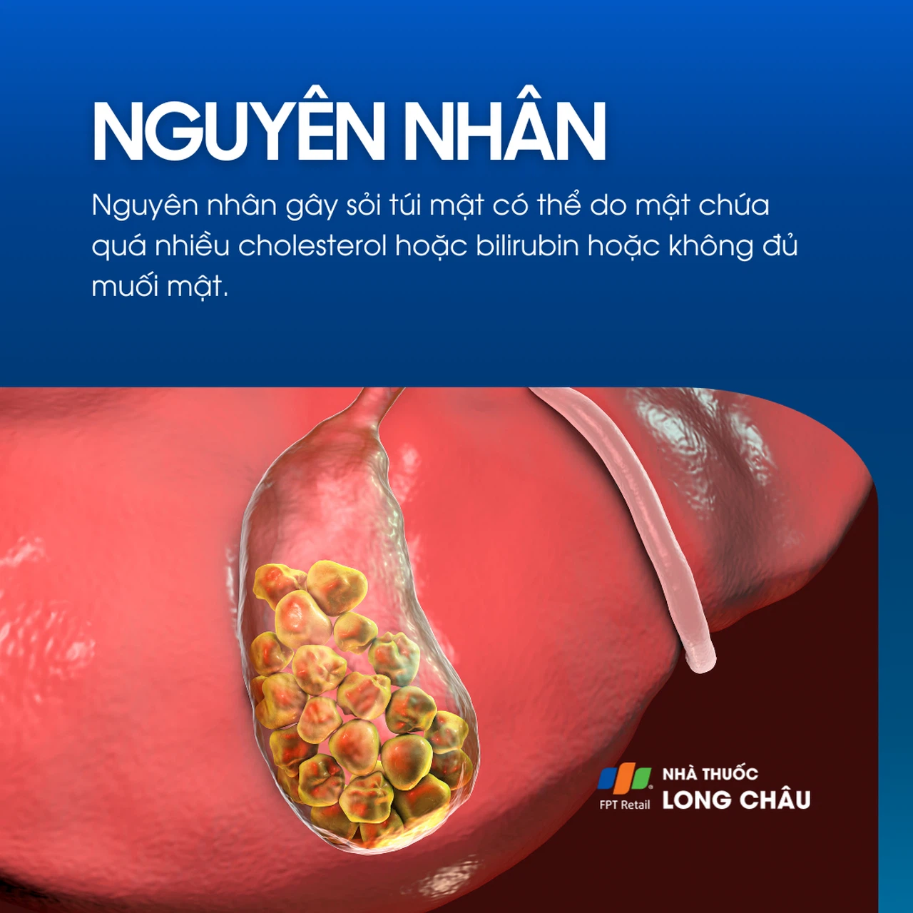 Sỏi túi mật 3