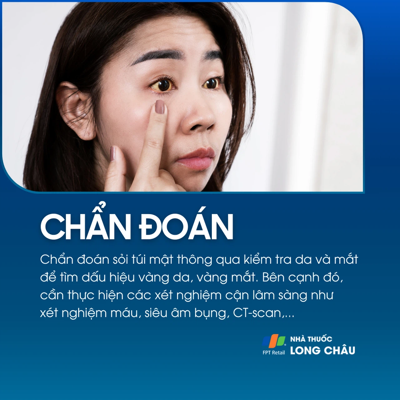 Sỏi túi mật 5