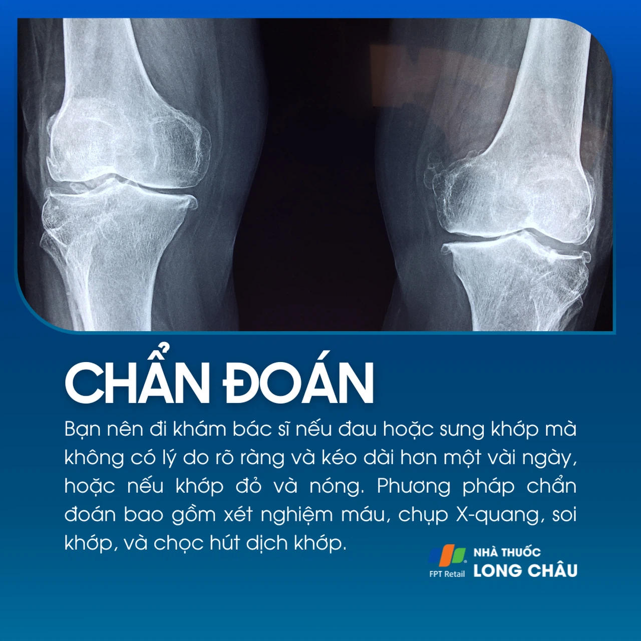 Sưng khớp 5