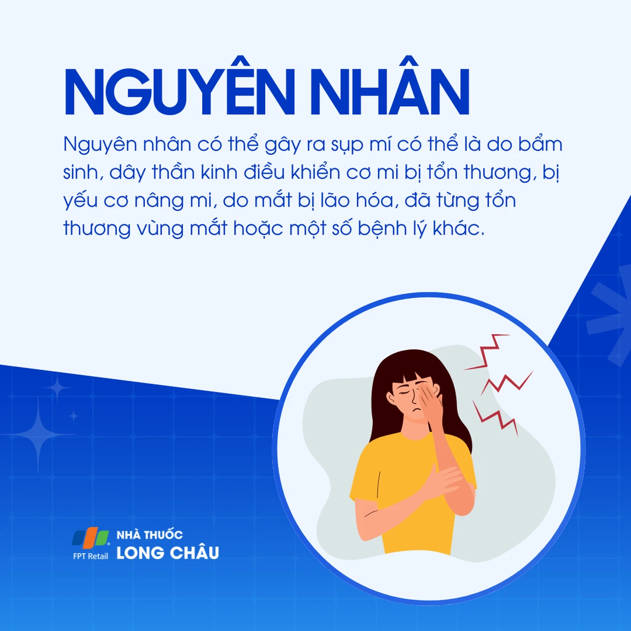 Sụp mí 3
