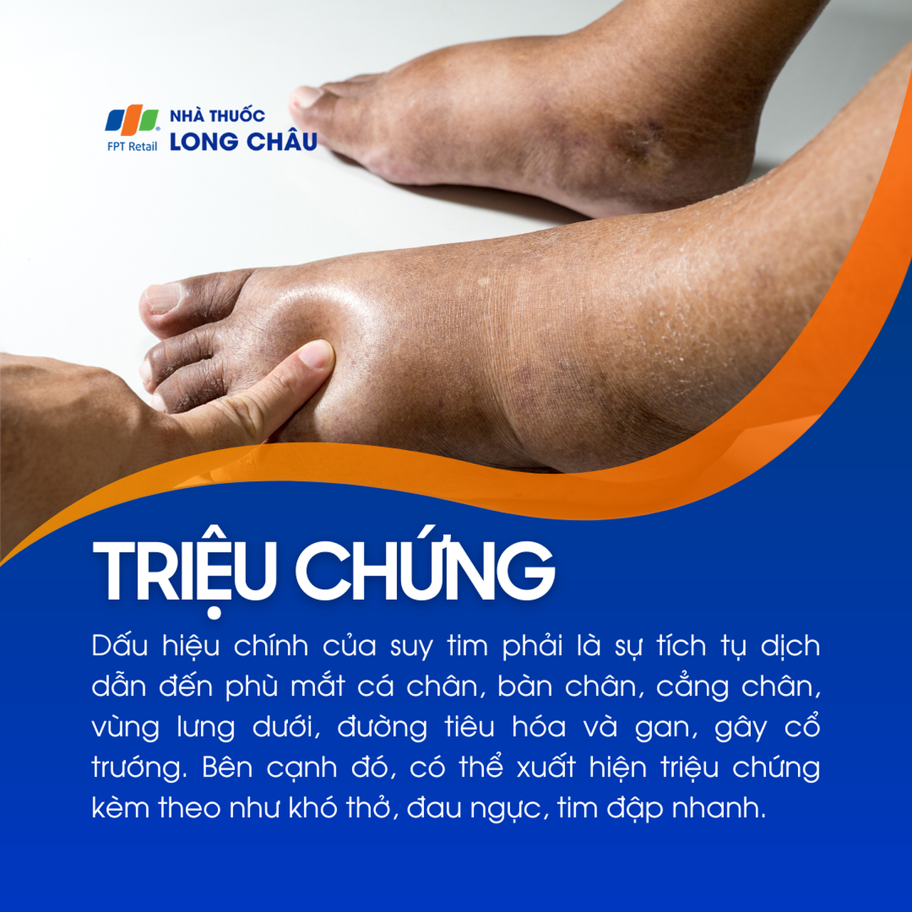 Suy tim phải 2
