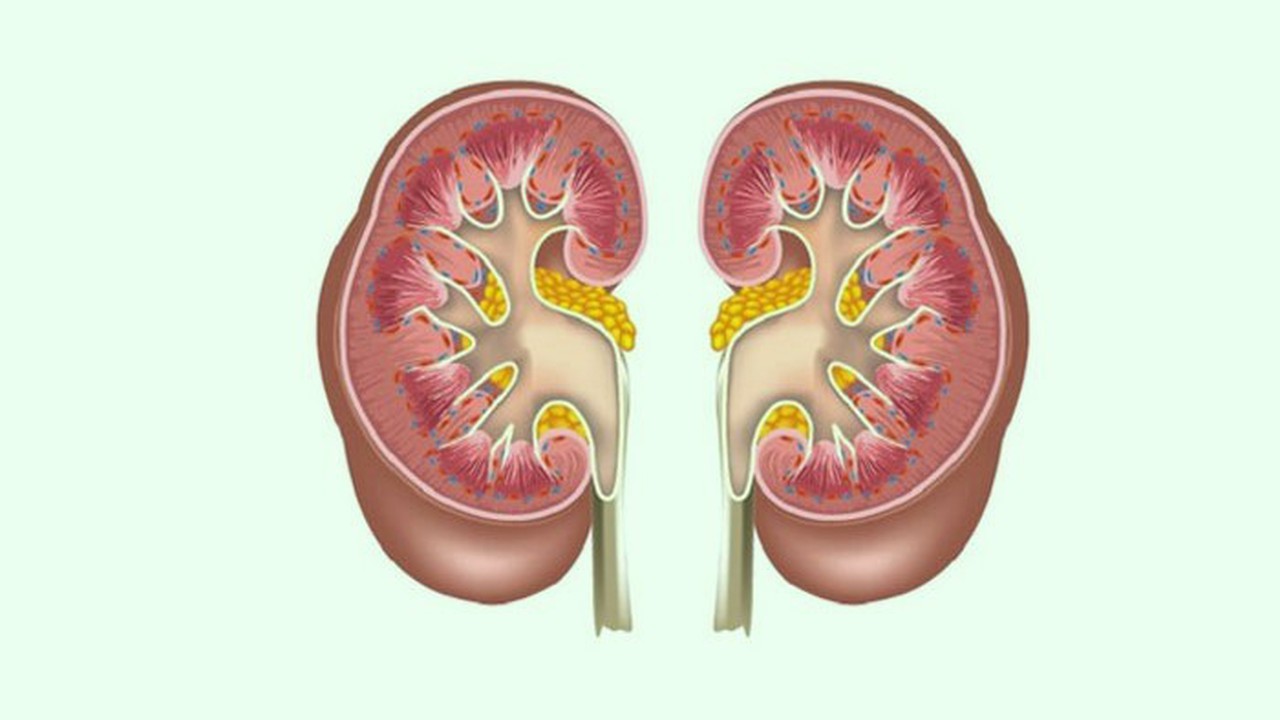 Thận nhiễm mỡ - Tìm hiểu về bệnh lý thận nhiễm mỡ