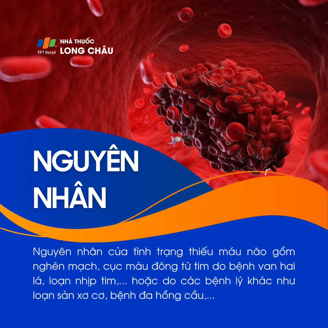 Thiếu máu não 3