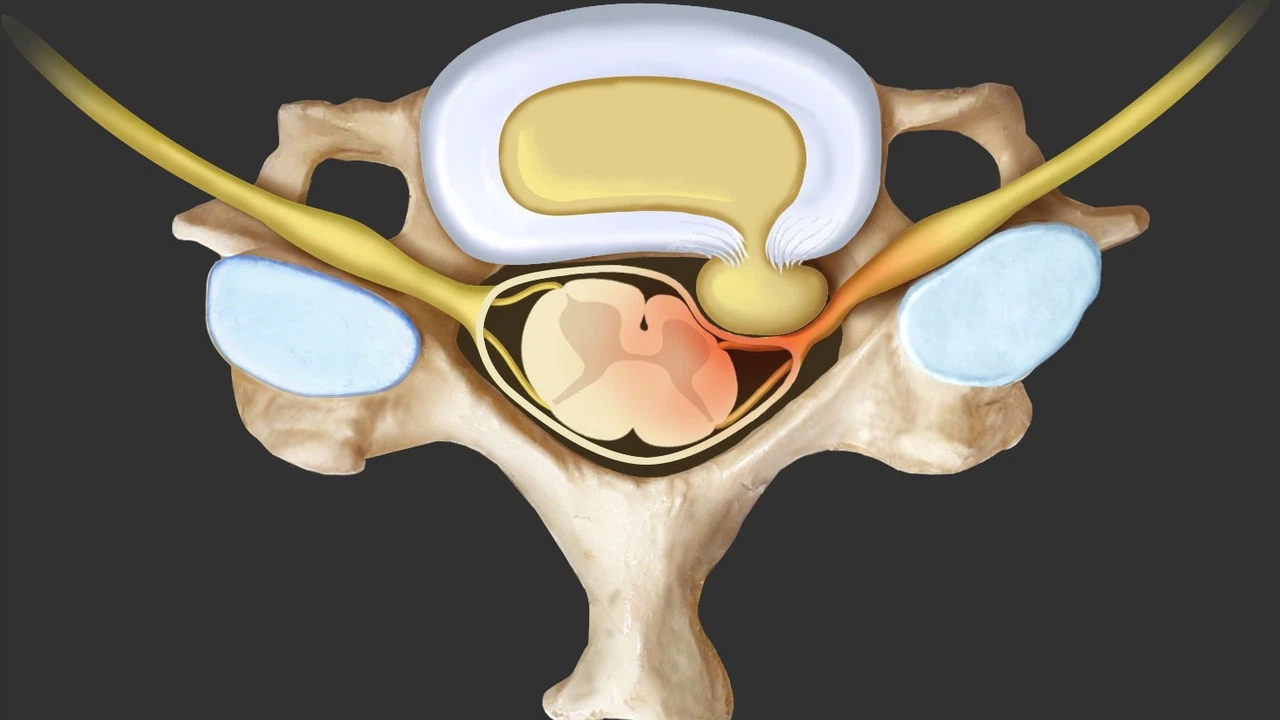 Thoát vị đĩa đệm là gì? Triệu chứng, nguyên nhân và cách điều trị 3