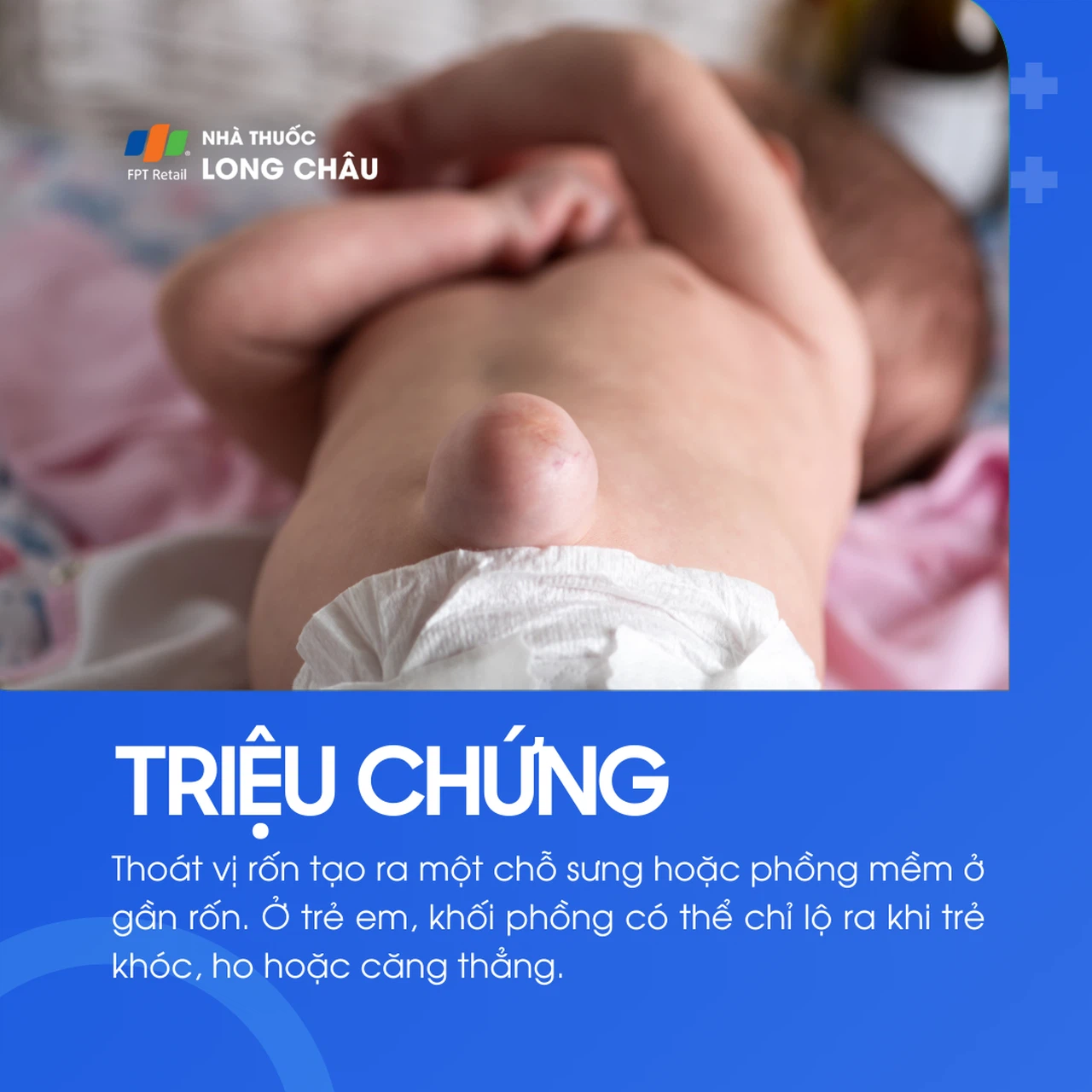 Thoát vị rốn 2
