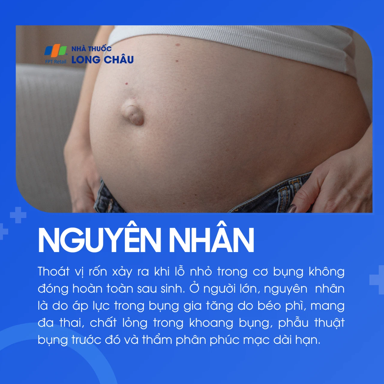 Thoát vị rốn 3