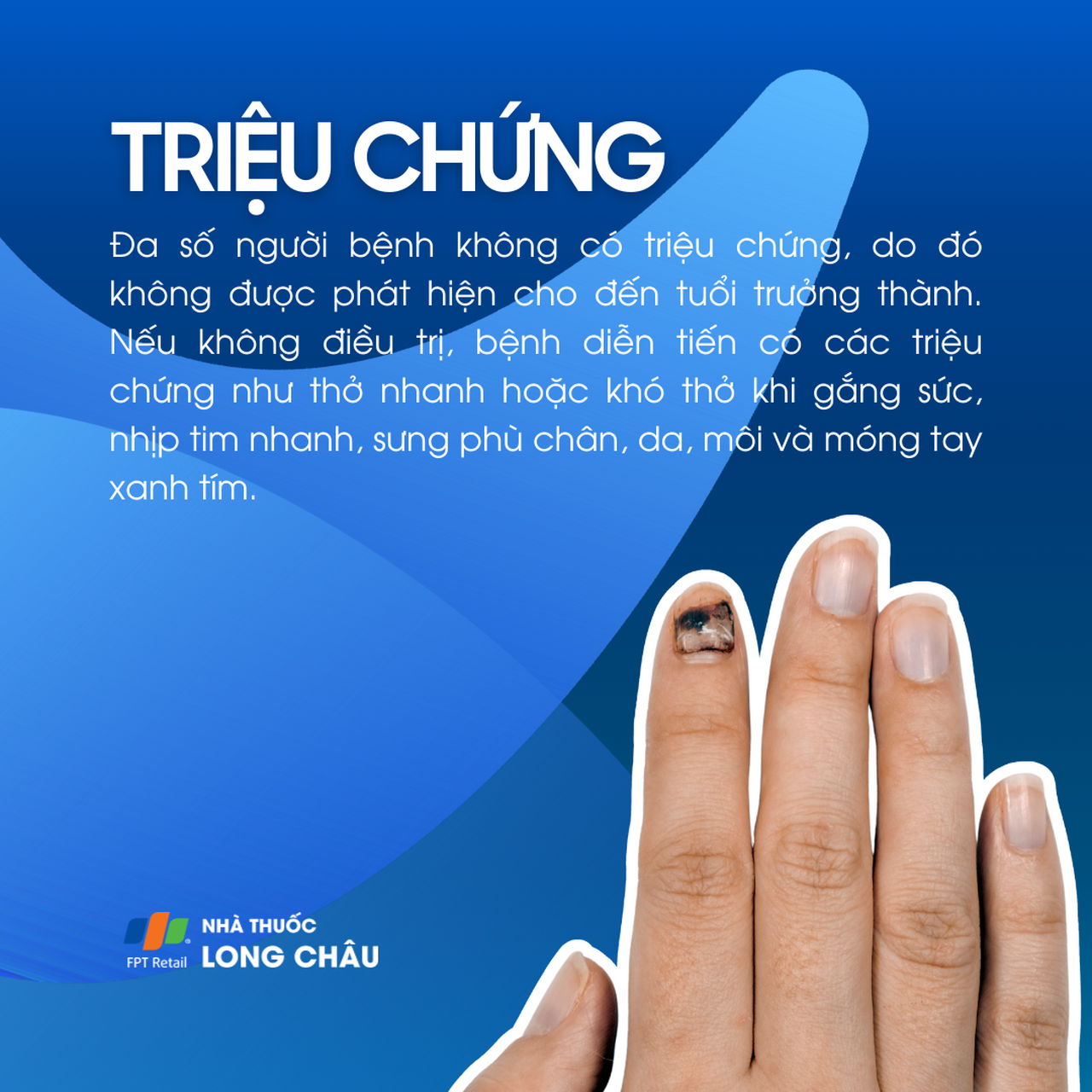 Thông liên nhĩ 2