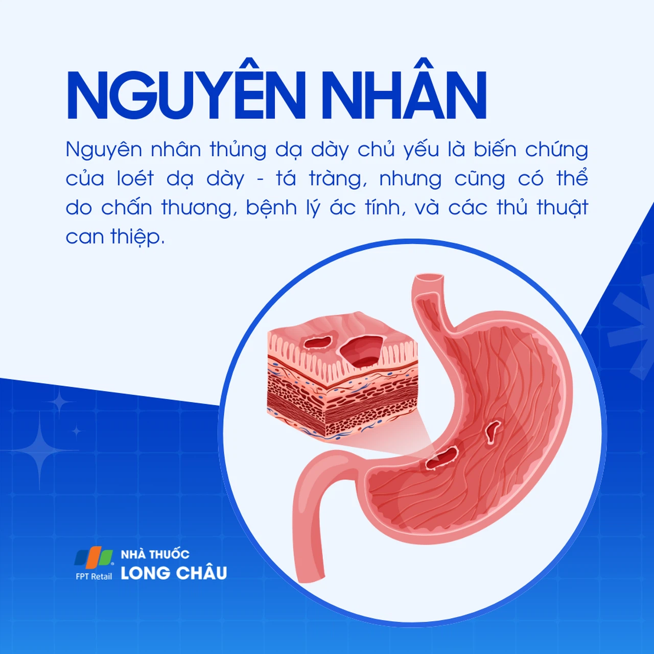 Thủng dạ dày 3