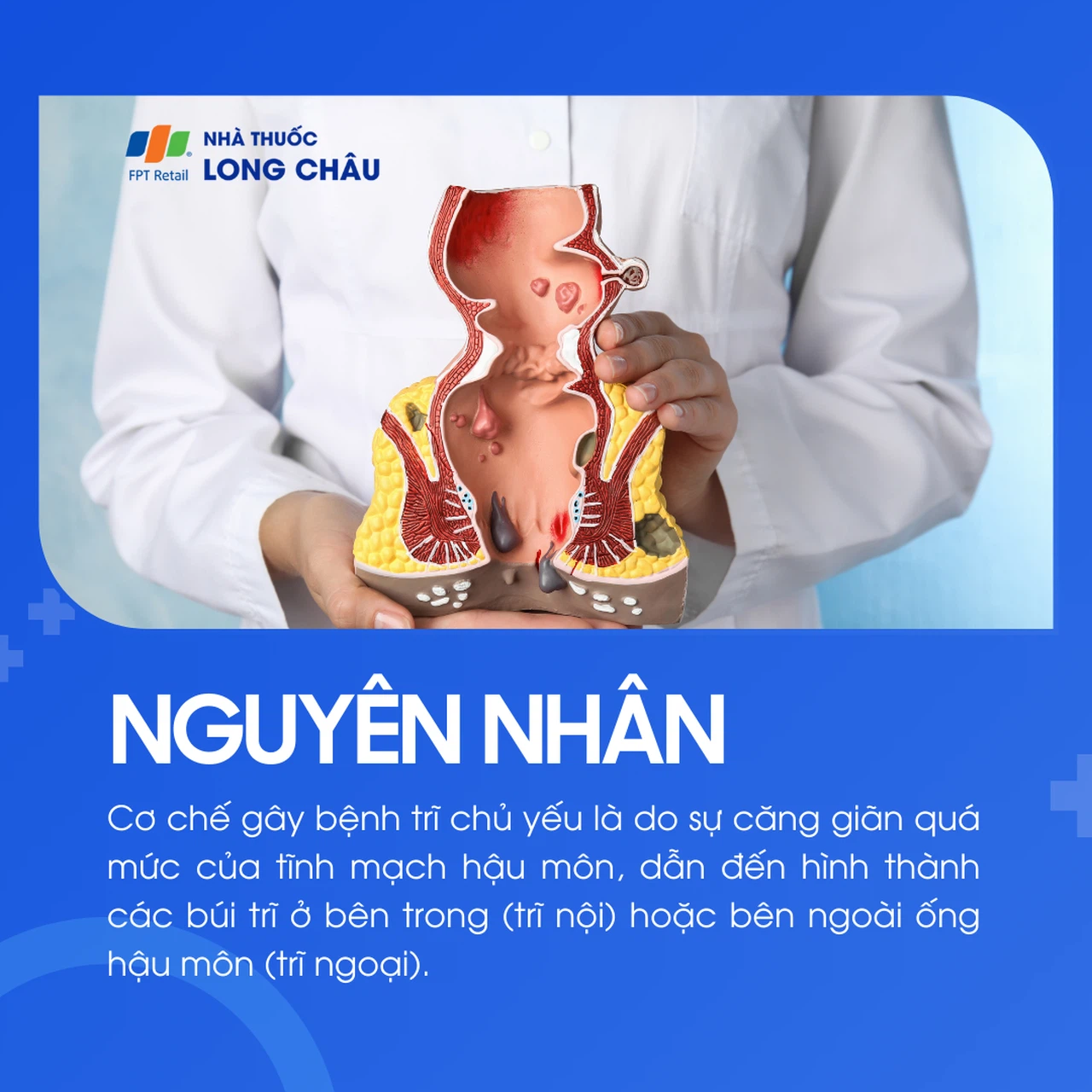 Bệnh trĩ 3