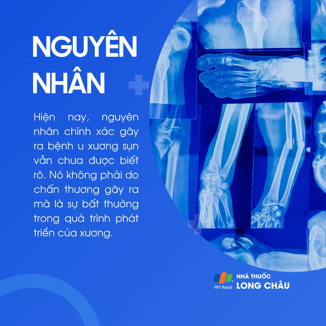 U xương sụn 3