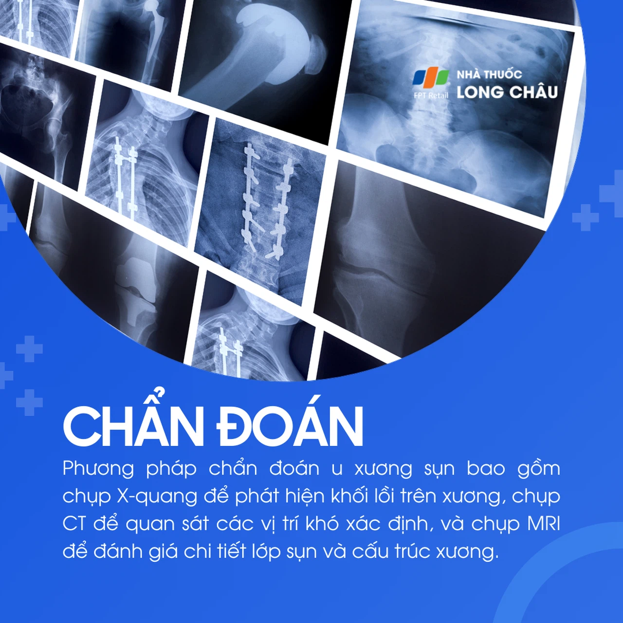 U xương sụn 5