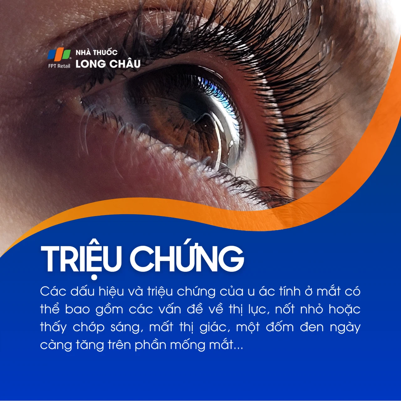 Ung thư mắt 2