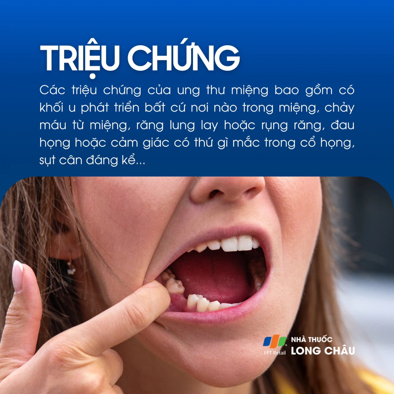 Ung thư miệng 2