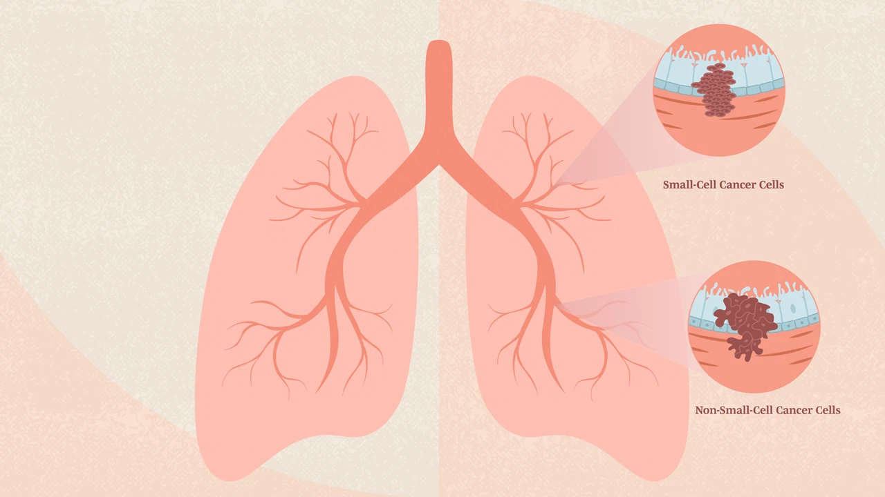 Ung thư phổi không tế bào nhỏ giai đoạn II: Hiểu rõ để điều trị tốt hơn 1