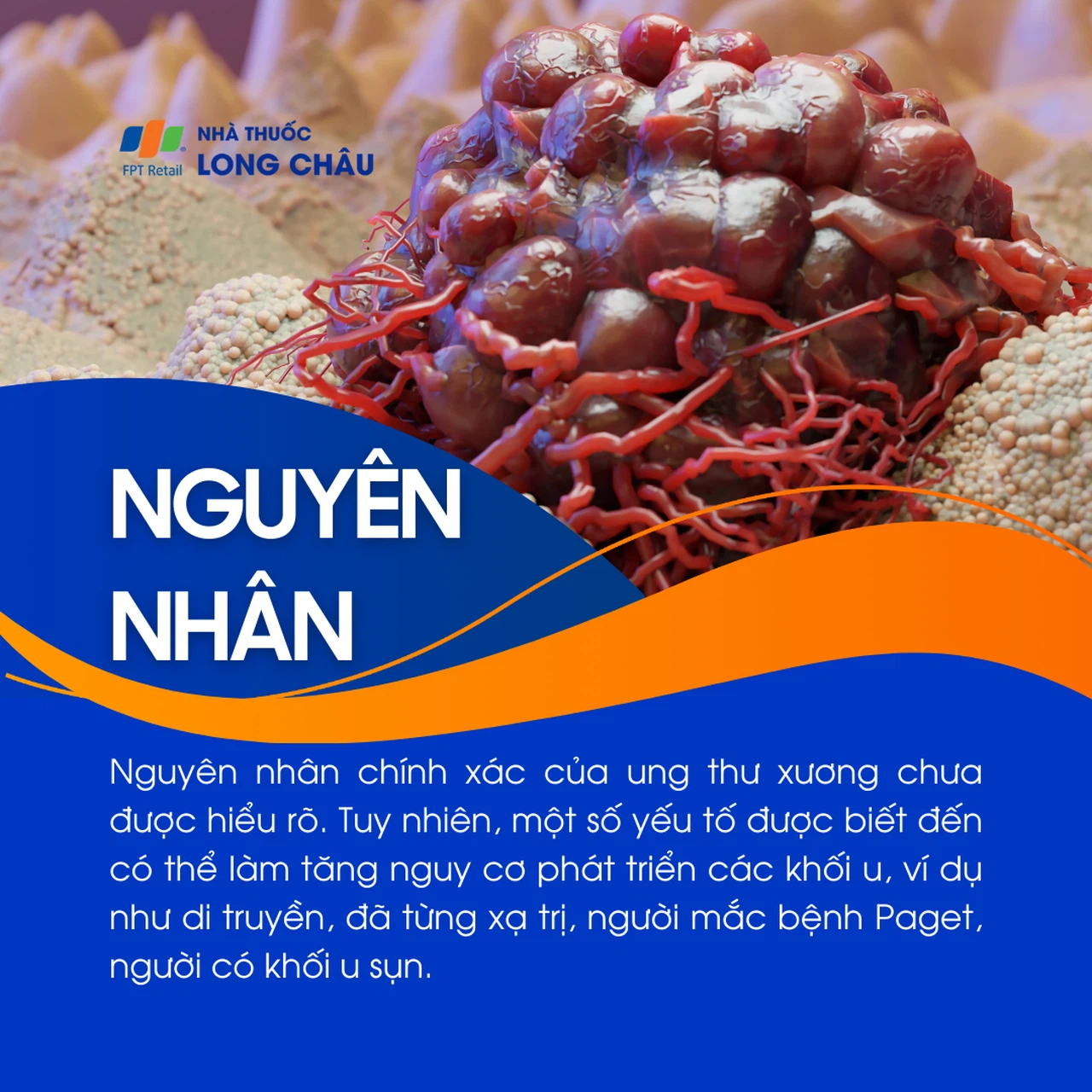 Ung thư xương 3