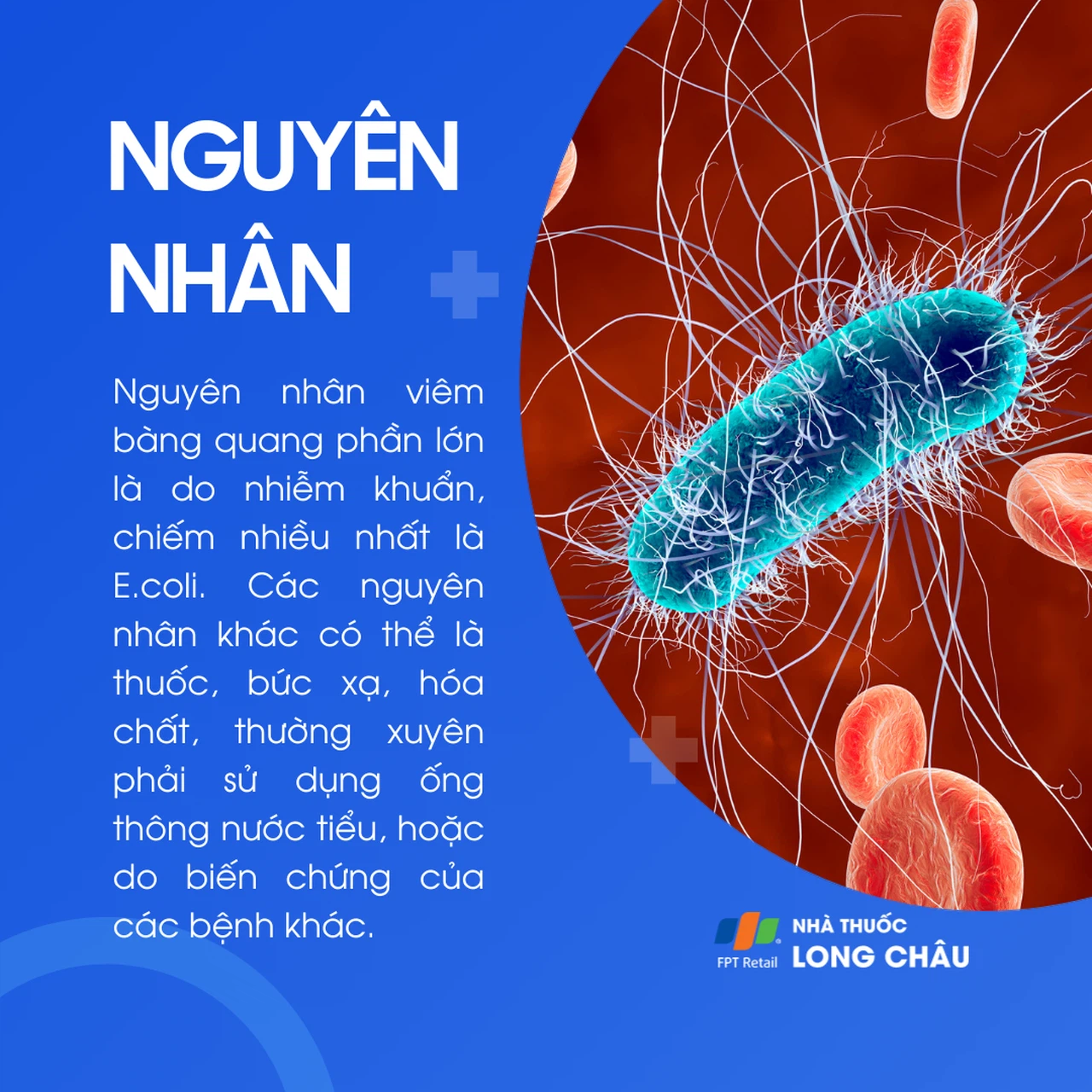 Viêm bàng quang 3