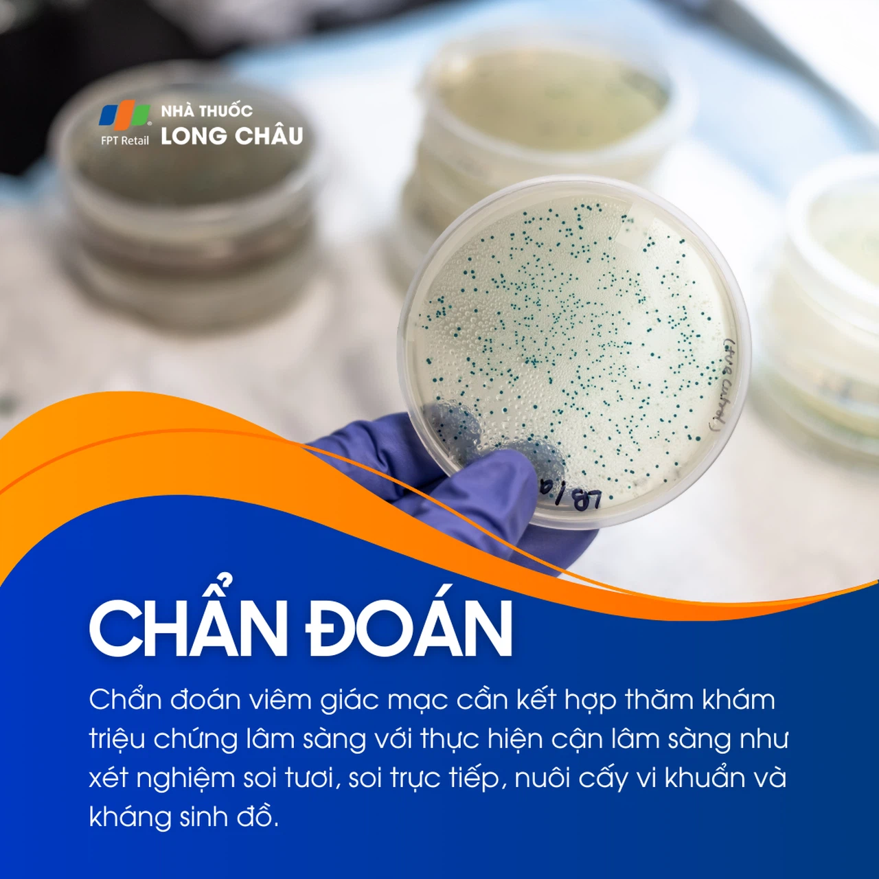 Viêm giác mạc 5