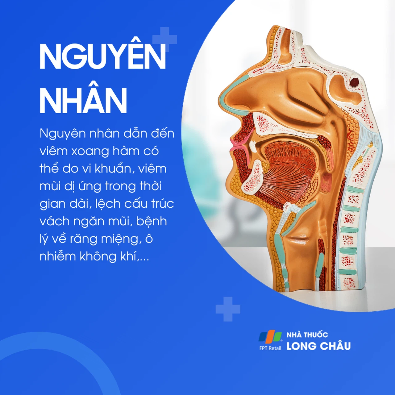 Viêm xoang hàm 3