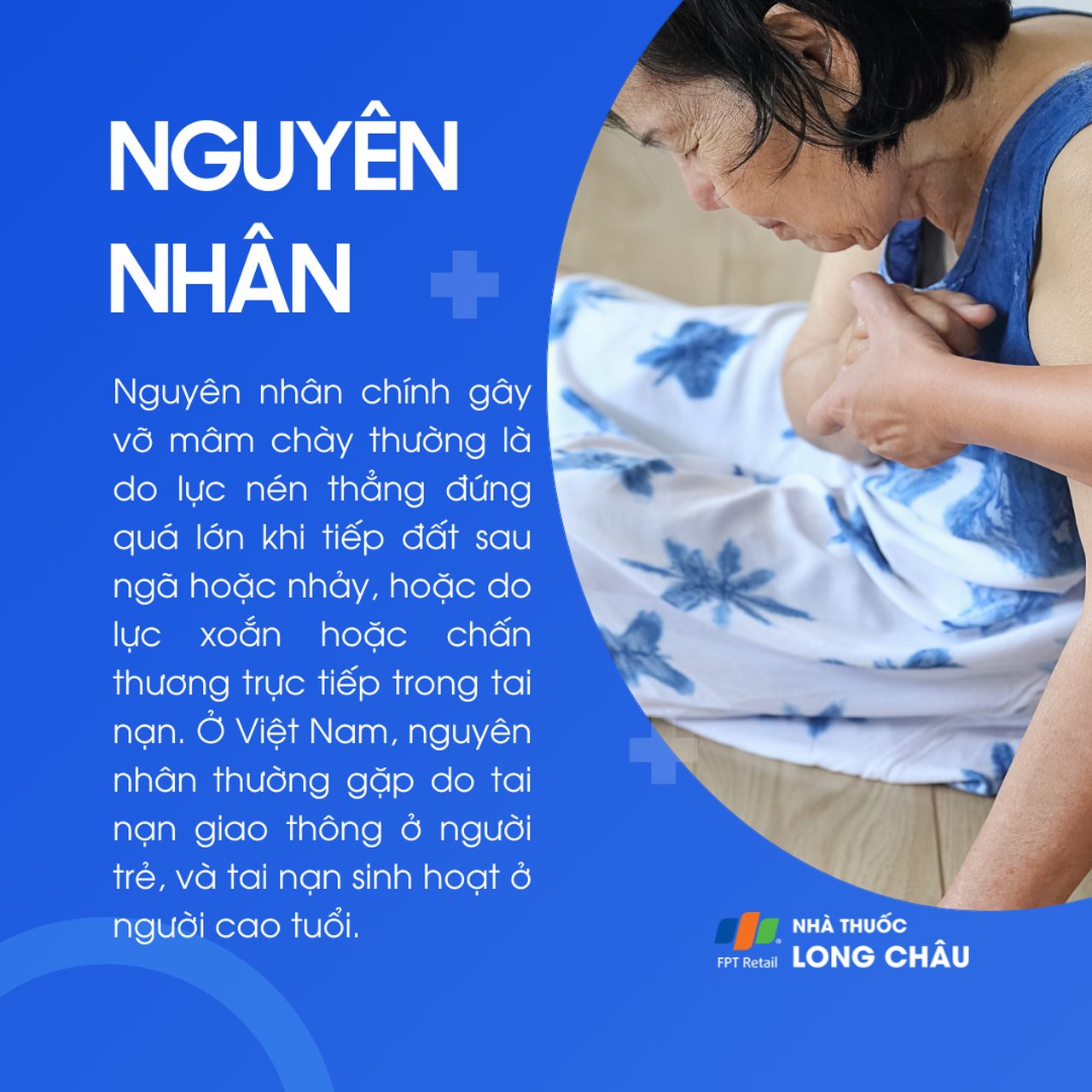 Vỡ mâm chày 3