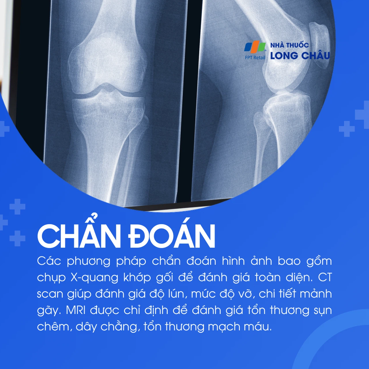 Vỡ mâm chày 5