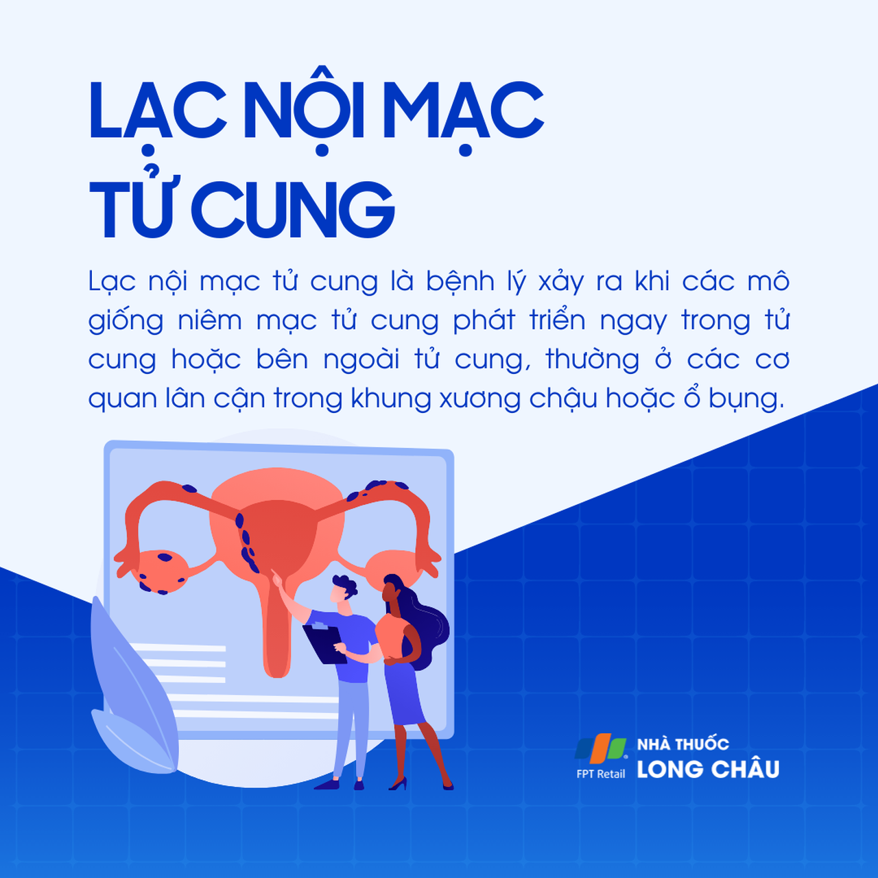 Lạc nội mạc tử cung 1