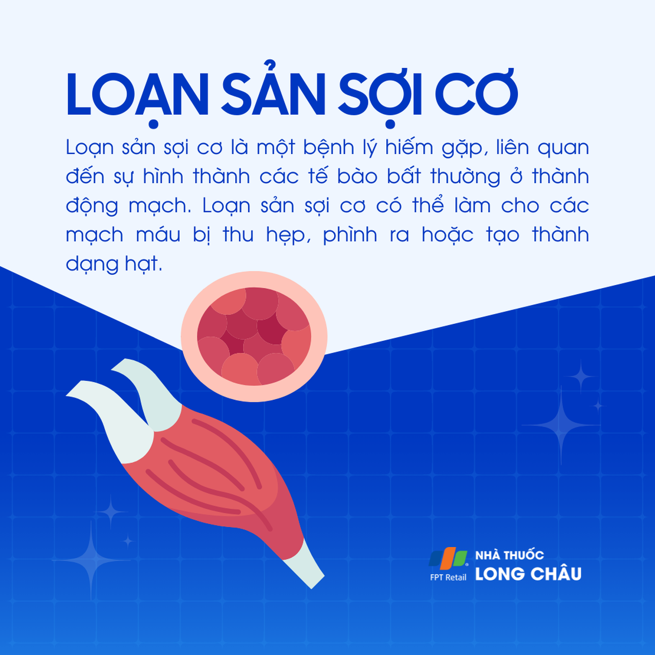 Loạn sản sợi cơ 1