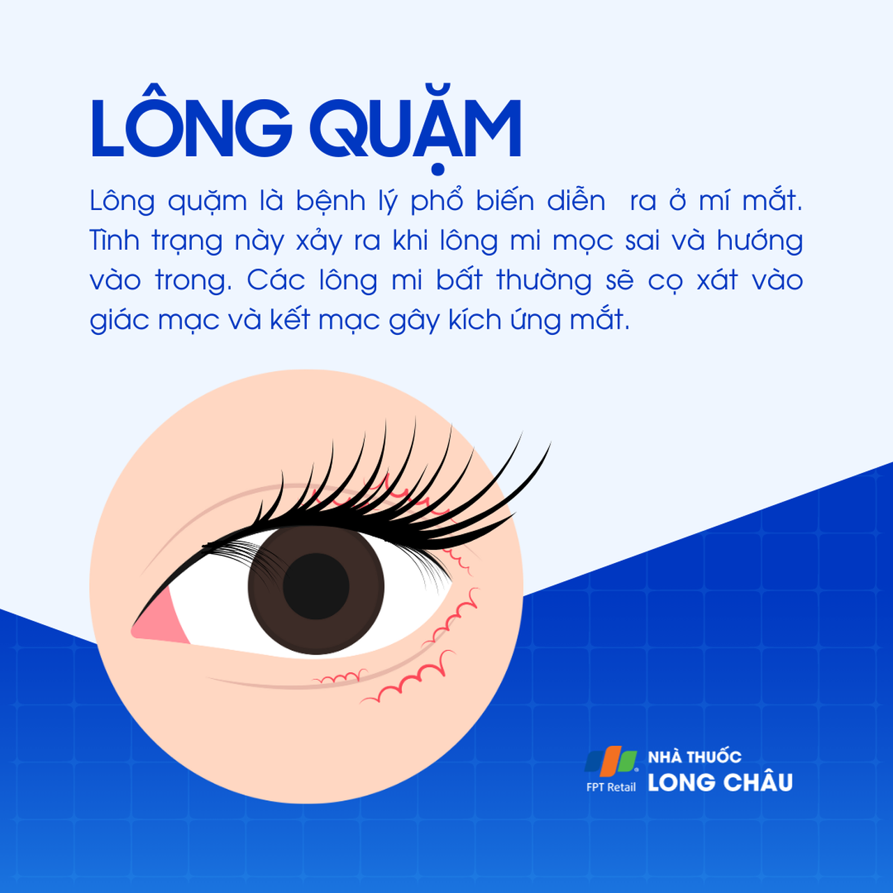 Lông quặm 1
