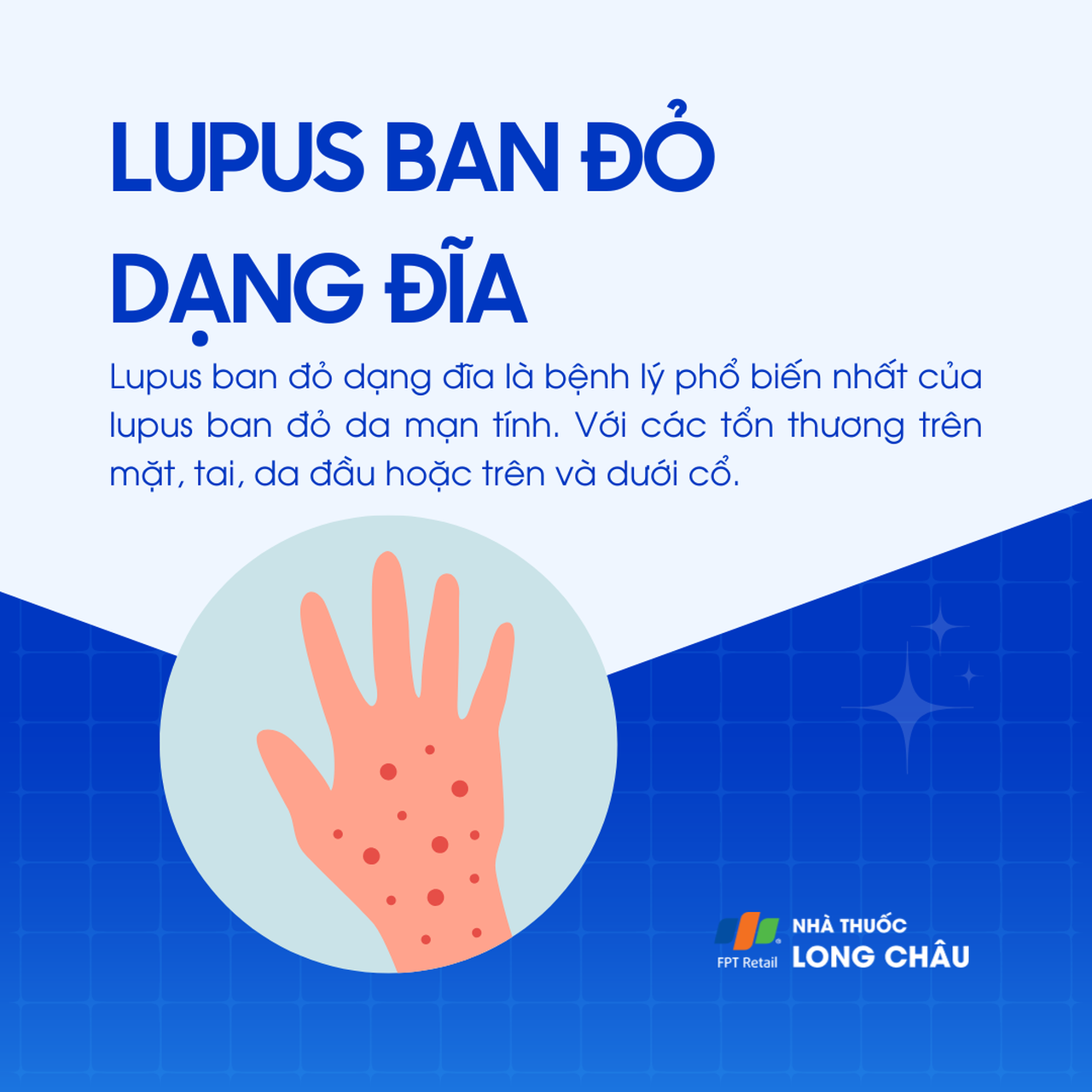 Lupus ban đỏ dạng đĩa 1